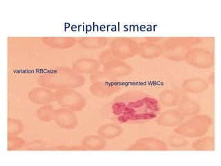 Peripheral smear
variation RBCsize
hypersegmented WBCs
 