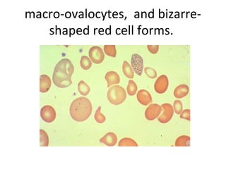 macro-ovalocytes, and bizarre-
shaped red cell forms.
 