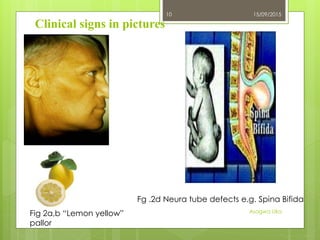 15/09/2015
Asogwa Uka
10
Fig 2a,b “Lemon yellow”
pallor
Fg .2d Neura tube defects e.g. Spina Bifida
Clinical signs in pictures
 
