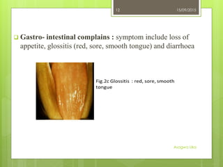  Gastro- intestinal complains : symptom include loss of
appetite, glossitis (red, sore, smooth tongue) and diarrhoea
15/09/2015
Asogwa Uka
12
 