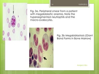 Fig. 3a. Peripheral smear from a patient
with megaloblastic anemia. Note the
hypersegmented neutrophils and the
macro-ovalocytes.
Fig. 3b Megaloblastosis (Giant
Band Forms in Bone Marrow)
15/09/2015
Asogwa Uka
14
 