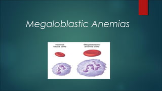 Megaloblastic Anemias
 