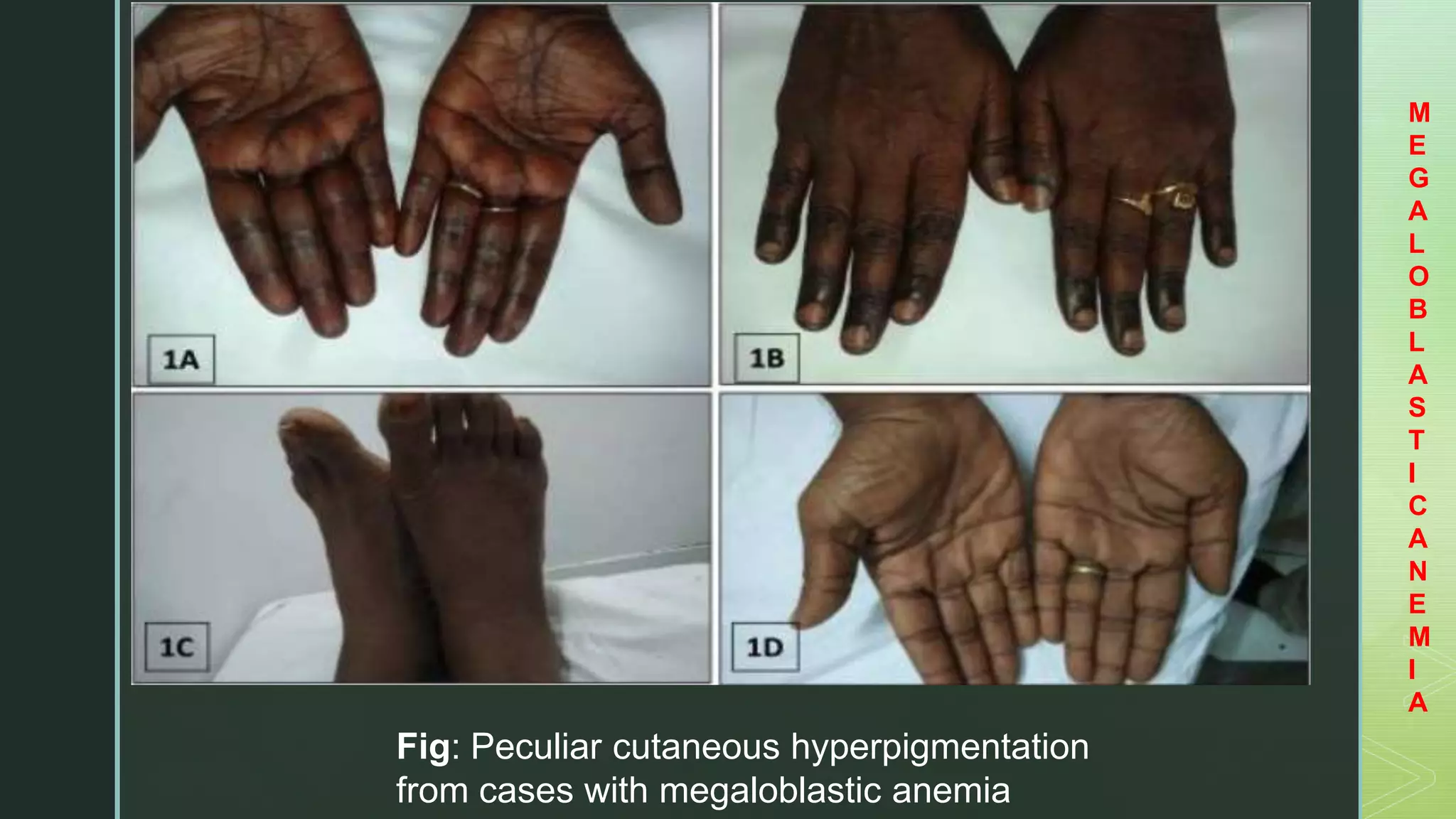 Megaloblastic Anemia And Pernicious Anemia PPTX megaloblastic-anemia-and-pernicious-anemia-pptx