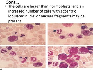 Cont…
• The cells are larger than normoblasts, and an
increased number of cells with eccentric
lobulated nuclei or nuclear fragments may be
present
 
