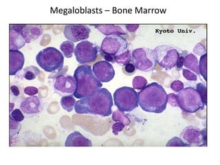 Megaloblastic Anemia Bone Marrow