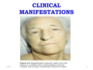 CLINICAL
MANIFESTATIONS
2/1/2024 31
 