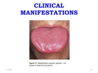 CLINICAL
MANIFESTATIONS
2/1/2024 32
 