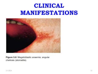 CLINICAL
MANIFESTATIONS
2/1/2024 33
 