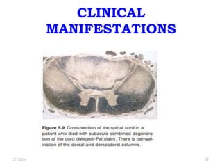 CLINICAL
MANIFESTATIONS
2/1/2024 35
 