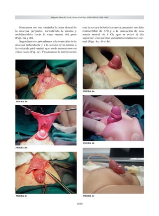 Mega Prepucio Congénito
