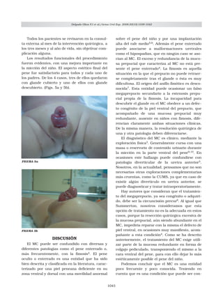 Mega Prepucio Congénito