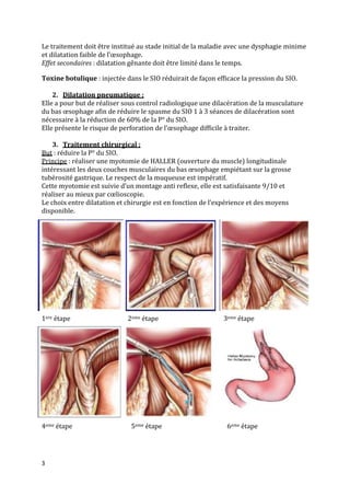 Le traitement doit être institué au stade initial de la maladie avec une dysphagie minime
et dilatation faible de l’œsophage.
Effet secondaires : dilatation gênante doit être limité dans le temps.
Toxine botulique : injectée dans le SIO réduirait de façon efficace la pression du SIO.
2. Dilatation pneumatique :
Elle a pour but de réaliser sous control radiologique une dilacération de la musculature
du bas œsophage afin de réduire le spasme du SIO 1 à 3 séances de dilacération sont
nécessaire à la réduction de 60% de la P° du SIO.
Elle présente le risque de perforation de l’œsophage difficile à traiter.
3. Traitement chirurgical :
But : réduire la P° du SIO.
Principe : réaliser une myotomie de HALLER (ouverture du muscle) longitudinale
intéressant les deux couches musculaires du bas œsophage empiétant sur la grosse
tubérosité gastrique. Le respect de la muqueuse est impératif.
Cette myotomie est suivie d’un montage anti reflexe, elle est satisfaisante 9/10 et
réaliser au mieux par cœlioscopie.
Le choix entre dilatation et chirurgie est en fonction de l’expérience et des moyens
disponible.

1ere étape

4eme étape

3

2eme étape

5eme étape

3eme étape

6eme étape

 