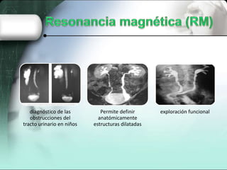 diagnóstico de las
obstrucciones del
tracto urinario en niños
Permite definir
anatómicamente
estructuras dilatadas
exploración funcional
 