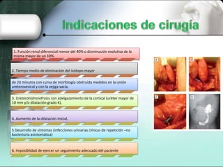 1. Función renal diferencial menor del 40% o disminución evolutiva de la
misma mayor de un 10%.
2. Tiempo medio de eliminación del isótopo mayor
de 20 minutos con curva de morfología obstruida medidos en la unión
ureterovesical y con la vejiga vacía.
3. Ureterohidronefrosis con adelgazamiento de la cortical (uréter mayor de
10 mm y/o dilatación grado 4).
4. Aumento de la dilatación inicial,
5 Desarrollo de síntomas (infecciones urinarias clínicas de repetición –no
bacteriuria asintomática)
6. Imposiblidad de ejercer un seguimiento adecuado del paciente
 