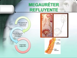 Por ausencia de
túnel vesical
submucoso
Relación fibras de
colágeno/fibras
musculares
megavejiga-
megauréter
 
