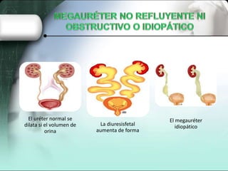 El uréter normal se
dilata si el volumen de
orina
La diuresisfetal
aumenta de forma
El megauréter
idiopático
 