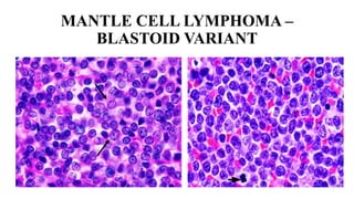 Meghana - neoplastic lesions of lymph node - part 1 | PPTX