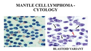 Meghana - neoplastic lesions of lymph node - part 1 | PPTX