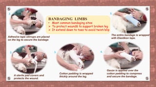 BANDAGING LIMBS
• Most common bandaging sites
 To protect wound& to support broken leg
 It extend down to toes to avoid twist/slip
Adhesive tape stirrups are placed
on the leg to secure the bandage.
A sterile pad covers and
protects the wound.
Cotton padding is wrapped
thickly around the leg.
Gauze is applied over the
cotton padding to compress
and secure the bandage.
The entire bandage is wrapped
with Elastikon tape.
1.
2. 3. 4.
5.
 