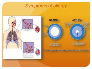 Symptoms of allergy
 