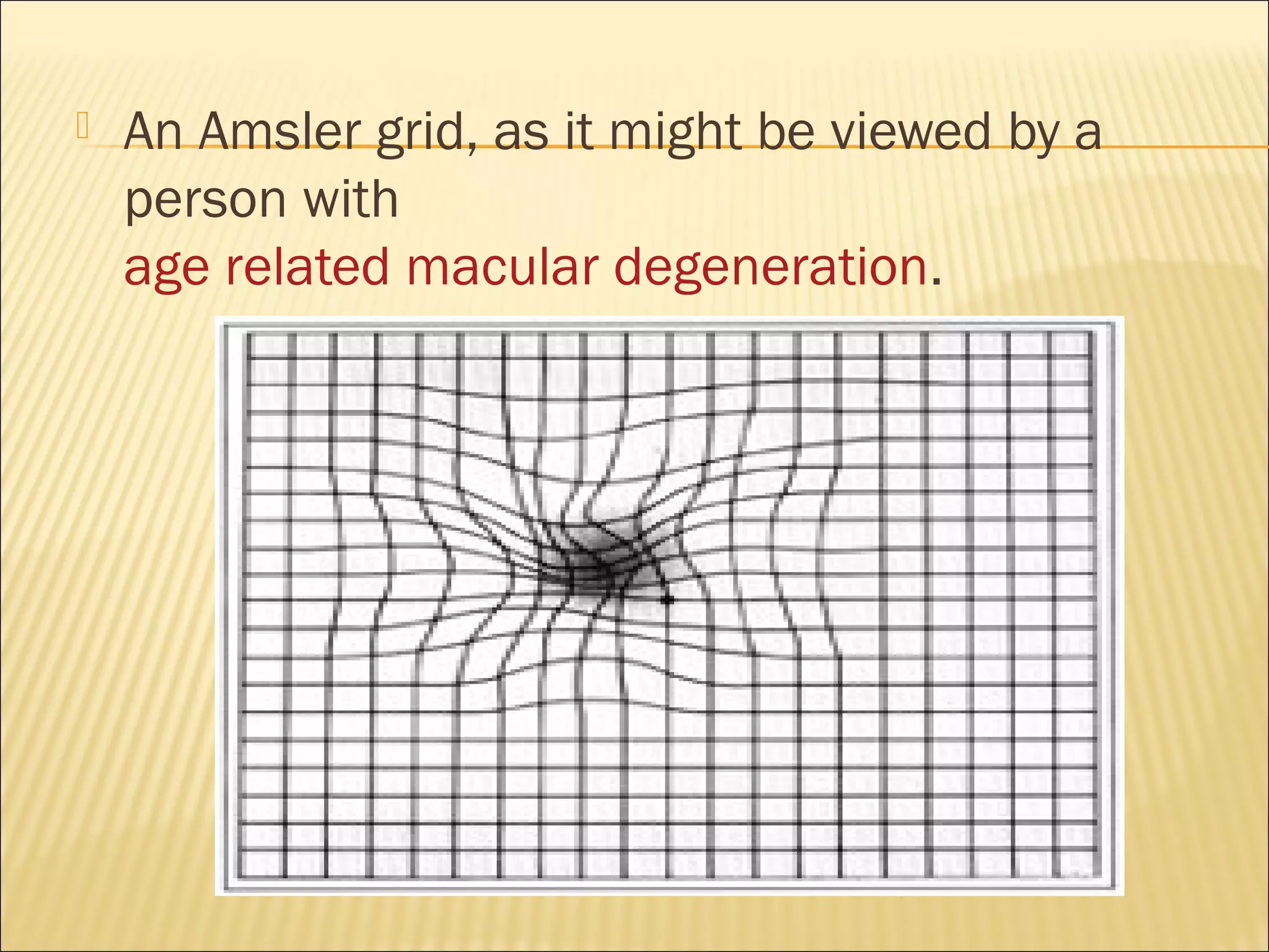  An Amsler grid, as it might be viewed by a
person with
age related macular degeneration.
 