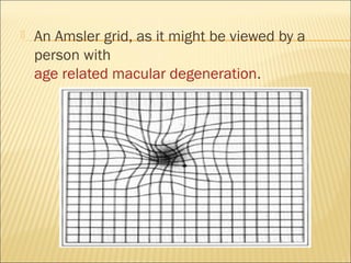  An Amsler grid, as it might be viewed by a
person with
age related macular degeneration.
 