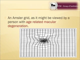  An Amsler grid, as it might be viewed by a
person with age related macular
degeneration.
 