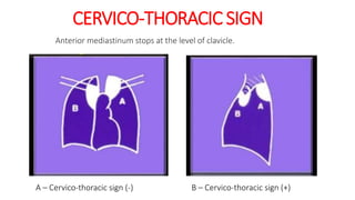 Stuart Sign Cervical Radioanatomy of mediastinum and approach to mediastinal masses | PPTX