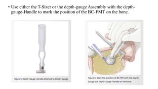 • Use either the T-Sizer or the depth-gauge Assembly with the depth-
gauge-Handle to mark the position of the BC-FMT on the bone.
 