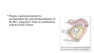 • Prepare a periosteal pocket to
accommodate the coil and demodulator of
the BCi, using the C-Sizer in combination
with the (Flat) T-Sizer.
 