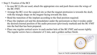• Step 5: Fixation of the BCI
• In case BCI Lifts are used, attach the appropriate size and push them onto the wings of
the BC-FMT.
• Arrange the BCi over the surgical site so that the magnet protrusion is towards the skull,
with the triangle shape on the magnet facing towards the skin.
• Bend the transition of the implant according to the final position required.
• Place the implant coil and the demodulator under the periosteum so that it resides under
the desired external position of the audio processor (previously marked) and the BC-FMT
into the bed that has been prepared.
• Place one regular cortical screw in each anchor hole of the BC-FMT and secure tightly.
The regular screws have a diameter of 2 mm, and a golden surface finish.
 
