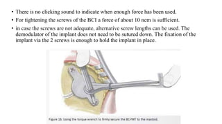 • There is no clicking sound to indicate when enough force has been used.
• For tightening the screws of the BCI a force of about 10 ncm is sufficient.
• in case the screws are not adequate, alternative screw lengths can be used. The
demodulator of the implant does not need to be sutured down. The fixation of the
implant via the 2 screws is enough to hold the implant in place.
 