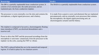 %
Bonebridge BAHA
The BB is a partially implantable bone conduction system. It
consists of an external part, the audio processor, and an
implanted part, the bone conduction implant.
The BAHA is a partially implantable bone conduction system.
The processor is worn externally over the skin and contains the
microphones, a digital signal processor, and a battery.
It is made from a passive screw and abutment that are implanted
percutaneously, and an externally worn processor that contains
the microphones, the digital signal processing unit, an
electromagnetic actuator and the battery.
The implant is composed of an active, electromagnetic floating
mass transducer (FMT), an electrical demodulator and a
receiver coil.
Power to drive the FMT and the processed recordings from the
microphone is sent trans- cutaneously from the processor to the
implant via the coils, causing the FMT to vibrate.
The FMT is placed behind the ear in the mastoid and temporal
regions. It is held in place by two titanium screws.
 