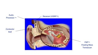 Audio
Processor TM
Receiver (VORPTM)
Conductor
lead
FMTTM
Floating Mass
Transducer
 