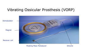 Vibrating Ossicular Prosthesis (VORP)
Demodulator
Receiver coil
Magnet
SiliconeFloating Mass Transducer
 