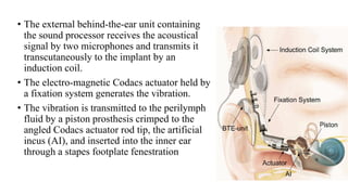 • The external behind-the-ear unit containing
the sound processor receives the acoustical
signal by two microphones and transmits it
transcutaneously to the implant by an
induction coil.
• The electro-magnetic Codacs actuator held by
a fixation system generates the vibration.
• The vibration is transmitted to the perilymph
fluid by a piston prosthesis crimped to the
angled Codacs actuator rod tip, the artificial
incus (AI), and inserted into the inner ear
through a stapes footplate fenestration
 