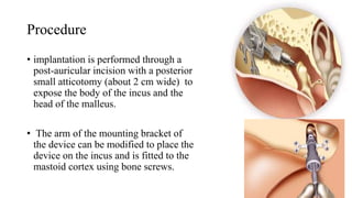Procedure
• implantation is performed through a
post-auricular incision with a posterior
small atticotomy (about 2 cm wide) to
expose the body of the incus and the
head of the malleus.
• The arm of the mounting bracket of
the device can be modified to place the
device on the incus and is fitted to the
mastoid cortex using bone screws.
 