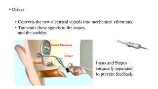 • Driver
• Converts the new electrical signals into mechanical vibrations.
• Transmits these signals to the stapes
and the cochlea
Sound Processor
Sensor
Driver
Incus and Stapes
surgically separated
to prevent feedback.
 