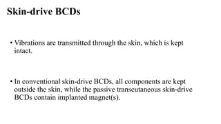 Skin-drive BCDs
• Vibrations are transmitted through the skin, which is kept
intact.
• In conventional skin-drive BCDs, all components are kept
outside the skin, while the passive transcutaneous skin-drive
BCDs contain implanted magnet(s).
 