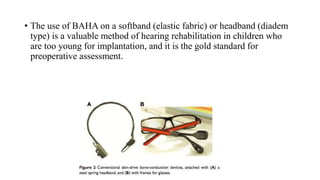 • The use of BAHA on a softband (elastic fabric) or headband (diadem
type) is a valuable method of hearing rehabilitation in children who
are too young for implantation, and it is the gold standard for
preoperative assessment.
 