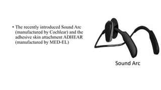 • The recently introduced Sound Arc
(manufactured by Cochlear) and the
adhesive skin attachment ADHEAR
(manufactured by MED-EL)
Sound Arc
 
