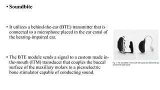 • Soundbite
• It utilizes a behind-the-ear (BTE) transmitter that is
connected to a microphone placed in the ear canal of
the hearing-impaired ear.
• The BTE module sends a signal to a custom made in-
the-mouth (ITM) transducer that couples the buccal
surface of the maxillary molars to a piezoelectric
bone stimulator capable of conducting sound.
 