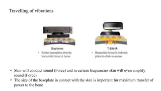 Travelling of vibrations
• Skin will conduct sound (Force) and in certain frequencies skin will even amplify
sound (Force)
• The size of the baseplate in contact with the skin is important for maximum transfer of
power to the bone
 
