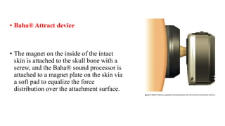 • Baha® Attract device
• The magnet on the inside of the intact
skin is attached to the skull bone with a
screw, and the Baha® sound processor is
attached to a magnet plate on the skin via
a soft pad to equalize the force
distribution over the attachment surface.
 