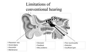 Limitations of
conventional hearing
aids
• Occlusion
• Feedback
• Wax problems
• Placement loss
• Social stigma
• Discomfort
• Maintenance
• Poor sound quality
• Distortion
• Insufficient gain
 