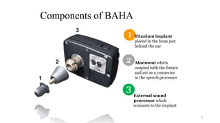 Components of BAHA
71
2
1 Titanium implant
placed in the bone just
behind the ear
Abutment which
coupled with the fixture
and act as a connector
to the speech processor1
2
3
3
External sound
processor which
connects to the implant
 
