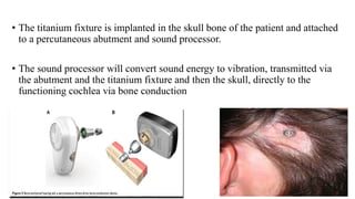 • The titanium fixture is implanted in the skull bone of the patient and attached
to a percutaneous abutment and sound processor.
• The sound processor will convert sound energy to vibration, transmitted via
the abutment and the titanium fixture and then the skull, directly to the
functioning cochlea via bone conduction
 