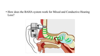 • How does the BAHA system work for Mixed and Conductive Hearing
Loss?
 