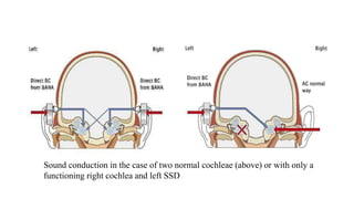 Sound conduction in the case of two normal cochleae (above) or with only a
functioning right cochlea and left SSD
 