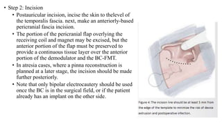 • Step 2: Incision
• Postauricular incision, incise the skin to thelevel of
the temporalis fascia. next, make an anteriorly-based
pericranial fascia incision.
• The portion of the pericranial flap overlying the
receiving coil and magnet may be excised, but the
anterior portion of the flap must be preserved to
provide a continuous tissue layer over the anterior
portion of the demodulator and the BC-FMT.
• In atresia cases, where a pinna reconstruction is
planned at a later stage, the incision should be made
further posteriorly.
• Note that only bipolar electrocautery should be used
once the BC is in the surgical field, or if the patient
already has an implant on the other side.
 